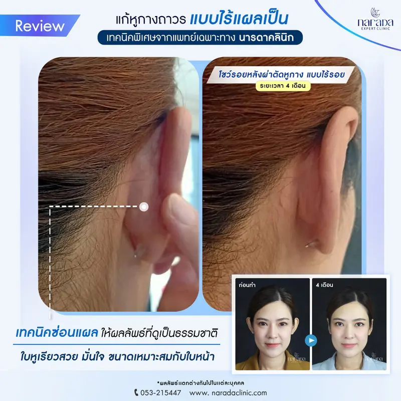 แก้หูกางถาวร "ไร้แผลเป็น" หูเรียวสวย ดูดีขึ้น  โดยแพทย์เฉพาะทาง #นารดาคลินิก แก้หูกางถาวร "ไร้แผลเป็น" หูเรียวสวย ดูดีขึ้น  โดยแพทย์เฉพาะทาง #นารดาคลินิก