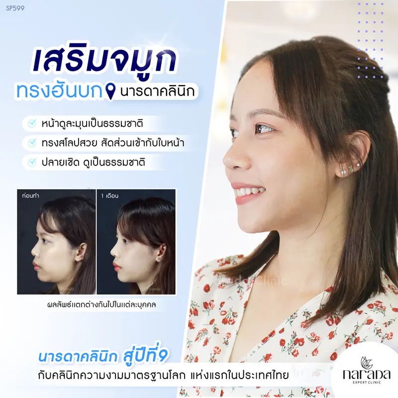 เสริมจมูก "หน้าดูสวย อย่างเป็นธรรมชาติ" ทรงฮันบก+เทคนิค Semi-open เฉพาะที่ นารดาคลินิก 