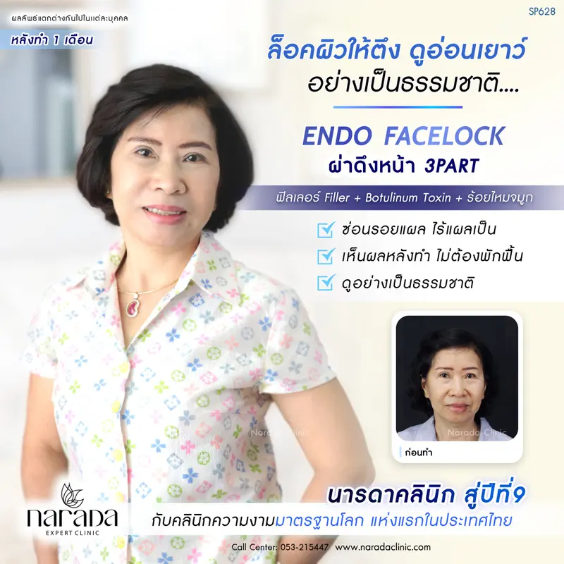 ล็อคผิวให้ตึง ดูอ่อนเยาว์ อย่างเป็นธรมชาติ ด้วย ENDO FACELOCK เทคนิคเฉพาะ #นารดาคลินิก
