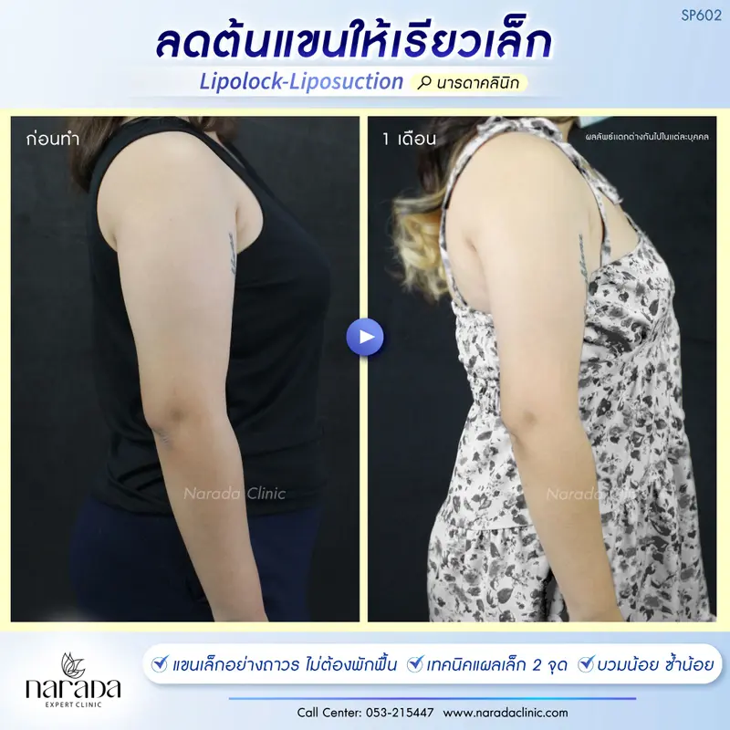 ลดต้นเเขนให้เรียวเล็ก ด้วยการดูดไขมันแขน Lipolock-Liposuction #นารดาคลินิก 