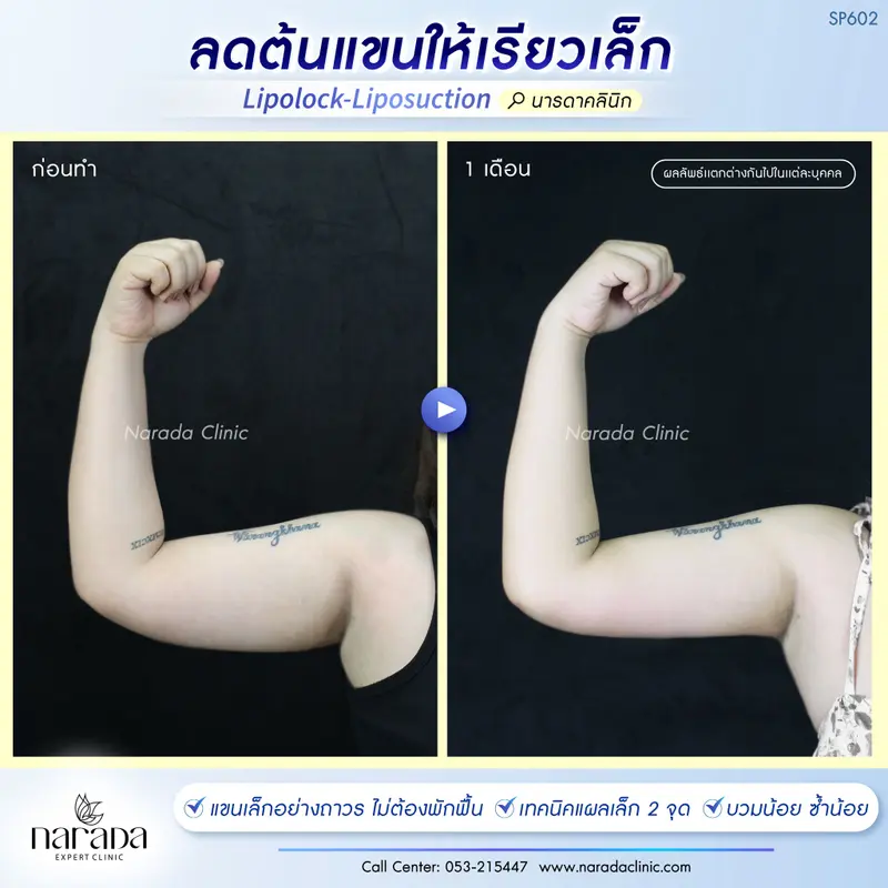 ลดต้นเเขนให้เรียวเล็ก ด้วยการดูดไขมันแขน Lipolock-Liposuction #นารดาคลินิก