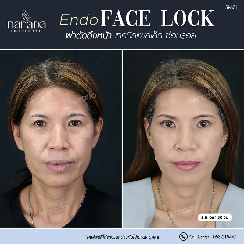 เปลี่ยนแปลงตัวเองให้สวยขึ้น และดูธรรมชาติ ด้วยการ ผ่าตัดดึงหน้า Endo Face Lock เทคนิคแผลเล็กซ่อนรอย