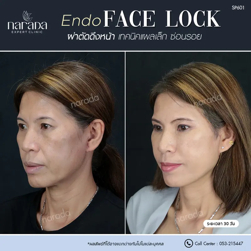 เปลี่ยนแปลงตัวเองให้สวยขึ้น และดูธรรมชาติ ด้วยการ ผ่าตัดดึงหน้า Endo Face Lock เทคนิคแผลเล็กซ่อนรอย