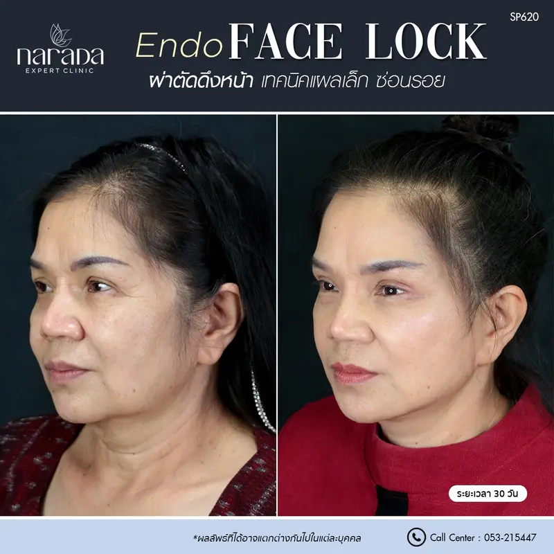 ใบหน้าตึงกระชับและเรียบเนียนขึ้น ด้วยการผ่าตัดดึงหน้า Endo Face Lock เทคนิคแผลเล็กซ่อนรอย 