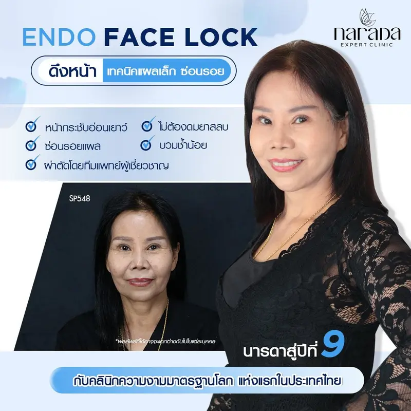 หน้าดูอ่อนวัย ผิวสดใสขึ้น ด้วยการผ่าตัดดึงหน้า Endo Face Lock เทคนิคแผลเล็กซ่อนรอยแผล ที่นารดาคลินิก