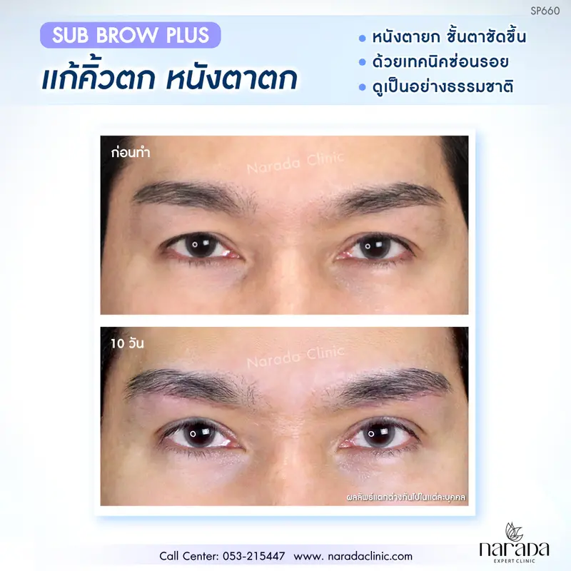 ตาและคิ้วยกขึ้น ชั้นตาชัดดูมีเสน่ห์ ด้วยการผ่าตัดยกคิ้ว Sub Brow Plus เทคนิคซ่อนรอยแผล 
