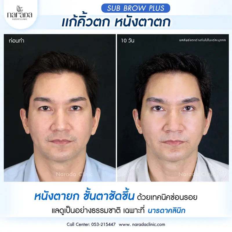 ตาและคิ้วยกขึ้น ชั้นตาชัดดูมีเสน่ห์ ด้วยการผ่าตัดยกคิ้ว Sub Brow Plus เทคนิคซ่อนรอยแผล 