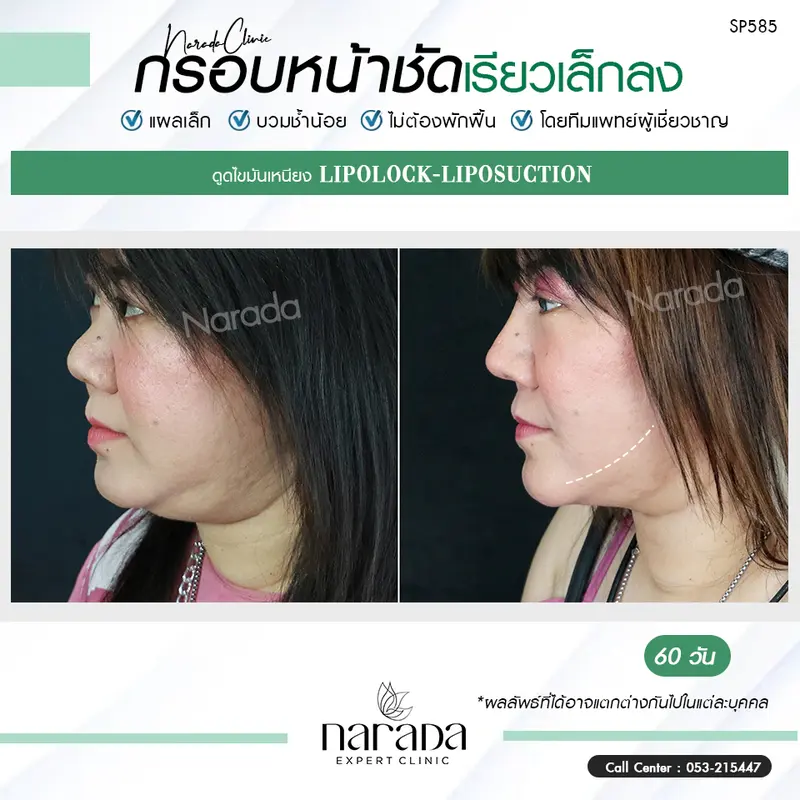 กรอบหน้าชัด เรียวเล็กลงได้ ด้วยการ ดูดไขมันเหนียง เทคนิคแผลเล็ก แบบไม่ต้องพักฟื้น ที่ นารดาคลินิก