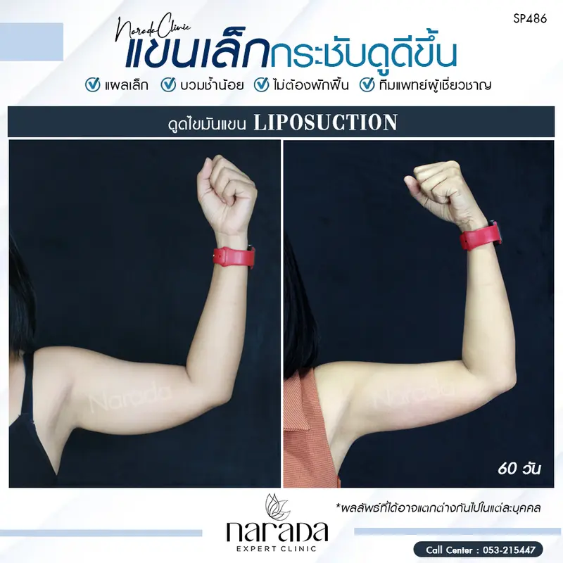 แขนเรียวเล็กได้รูป กระชับดูดีขึ้นได้ ด้วยการดูดไขมันแขน Lipo Lock-Liposuction แบบไม่ต้องพักฟื้น 