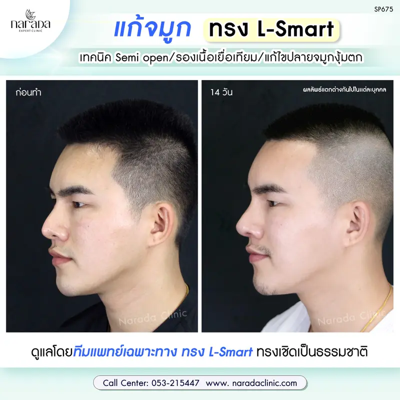 งานแก้ปลายงุ้ม ปลายตก ปลายบางใส เสี่ยงทะลุ แก้ไขอย่างตรงจุด โดยแพทย์เชี่ยวชาญ #นารดาคลินิก