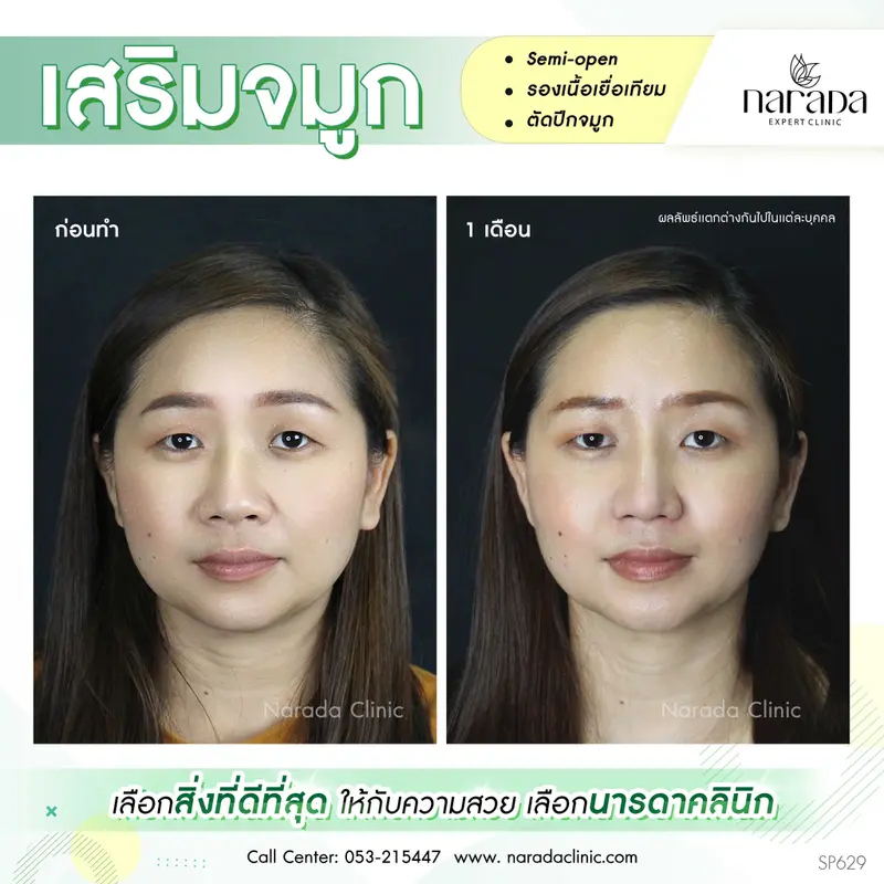 เสริมจมูกเพิ่มมิติให้กับใบหน้า ที่ นารดาคลินิก เทคนิค semi-open+รองเนื้อเยื่อเทียม+ตัดปีกจมูก