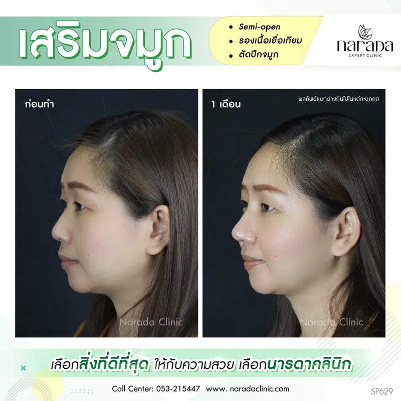 เสริมจมูกเพิ่มมิติให้กับใบหน้า ที่ นารดาคลินิก เทคนิค semi-open+รองเนื้อเยื่อเทียม+ตัดปีกจมูก