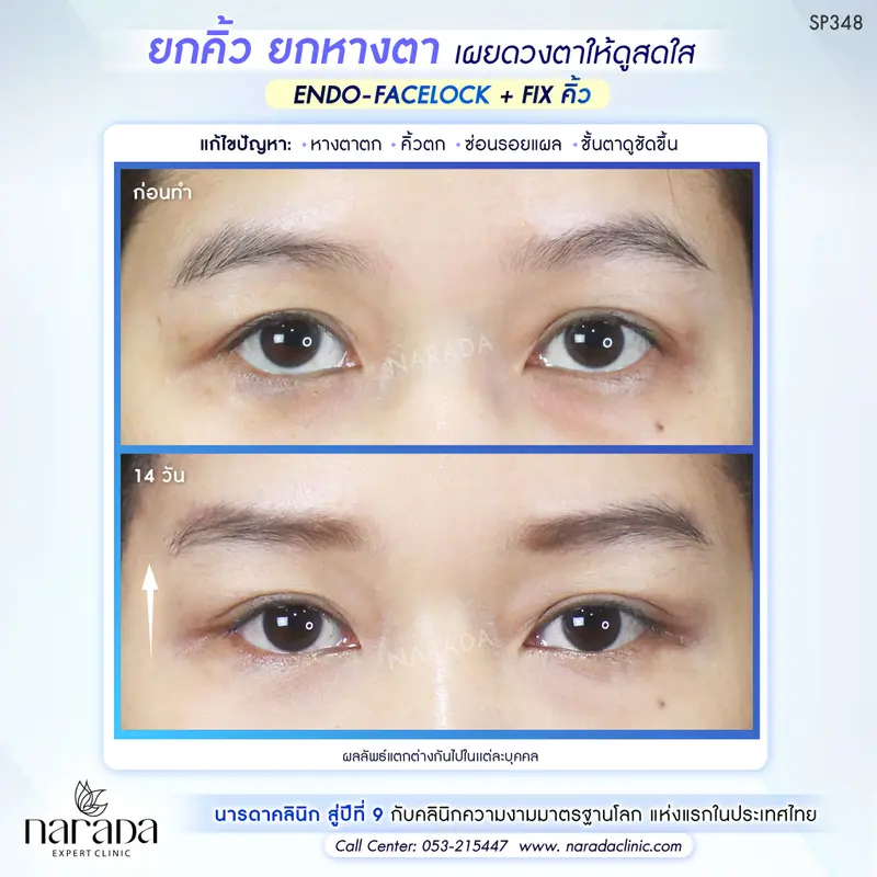 ยกคิ้ว ยกหางตา เผยดวงตาให้ดูสดใส ENDO - FACELOCK+FIXคิ้ว #นารดาคลินิก