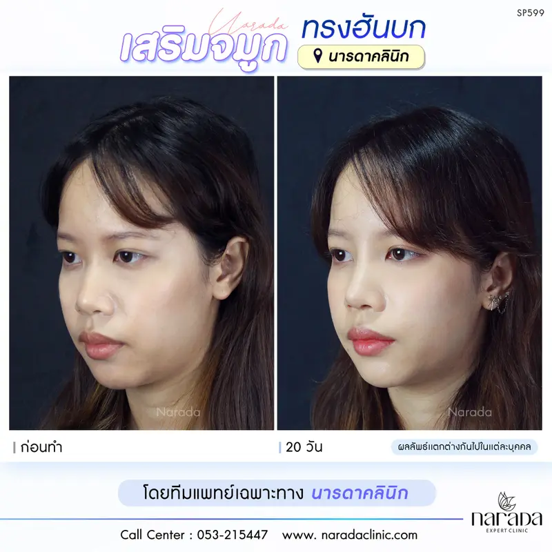 หน้าละมุนหวานขึ้นอย่างเป็นธรรมชาติ ด้วยเทคนิค Semi-open ที่ นารดาคลินิก