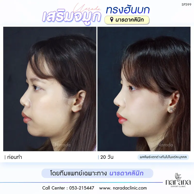 หน้าละมุนหวานขึ้นอย่างเป็นธรรมชาติ ด้วยเทคนิค Semi-open ที่ นารดาคลินิก 