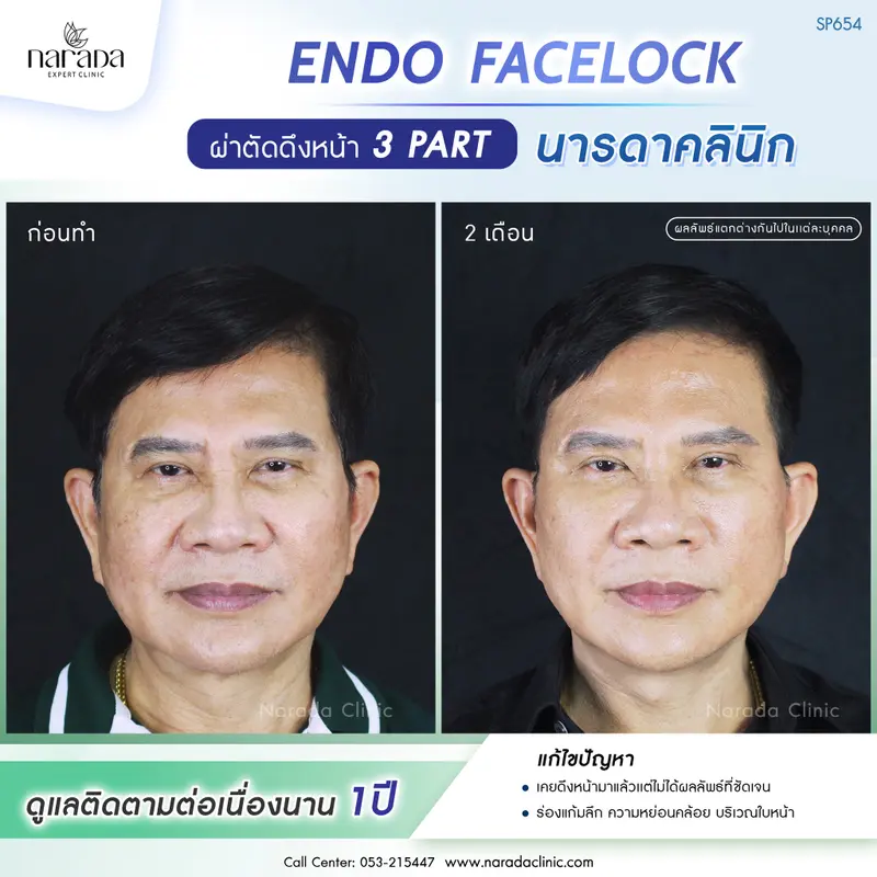 แก้ไขปัญหาที่เคยดึงหน้ามาเเล้ว แต่ผลลัพธ์ไม่ชัด ด้วย ENDO FACELOCK #นารดาคลินิก ยกกระชับ 4 ชั้น
