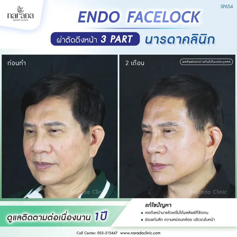 แก้ไขปัญหาที่เคยดึงหน้ามาเเล้ว แต่ผลลัพธ์ไม่ชัด ด้วย ENDO FACELOCK #นารดาคลินิก ยกกระชับ 4 ชั้น