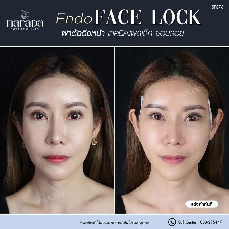 ดึงหน้าพาร์ทบน Endo FaceLock ในคนวัย40++ ดึงหน้า ย้อนวัย ไร้รอยแผลเป็น