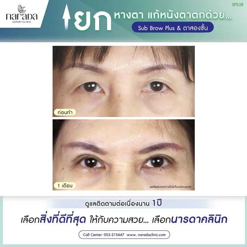 ยกหางตา แก้หนังตาตก ด้วย SUB BROW PLUS และตาสองชั้น เทคนิคโดยแพทย์ผู้เชี่ยวชาญ นารดาคลินิก