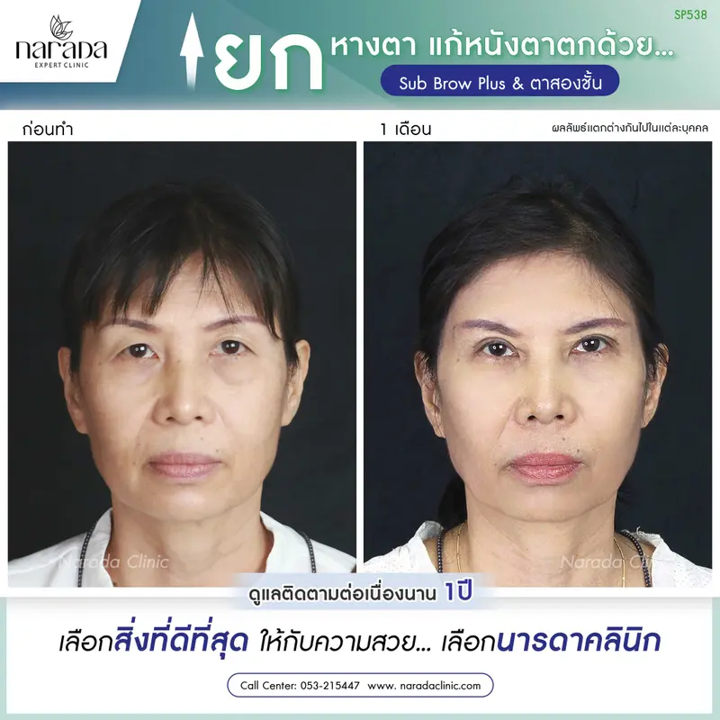 ยกหางตา แก้หนังตาตก ด้วย SUB BROW PLUS และตาสองชั้น เทคนิคโดยแพทย์ผู้เชี่ยวชาญ นารดาคลินิก