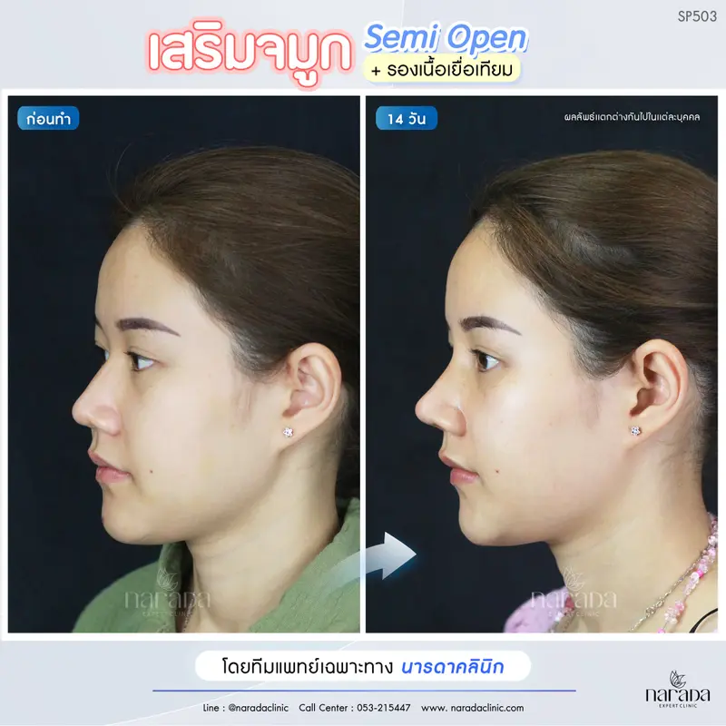 จมูกปลายเชิดดูสวยมีเสน่ห์+รองเนื้อเยื่อเทียม เทคนิค Semi Open #นารดาคลินิก