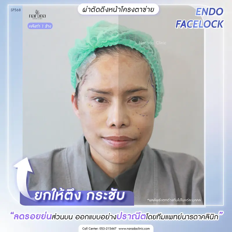 ยกอย่างตึงกระชับ.. " 4 ระดับชั้นผิว" เทคนิค ENDO FACELOCK เฉพาะที่ นารดาคลินิก