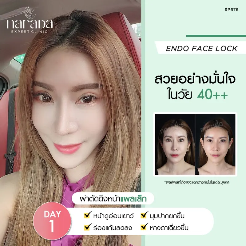  สวยอย่างมั่นใจ ในวัยใกล้ 40+ ด้วยการผ่าตัดดึงหน้า Endo Face Lock ที่ นารดาคลินิก