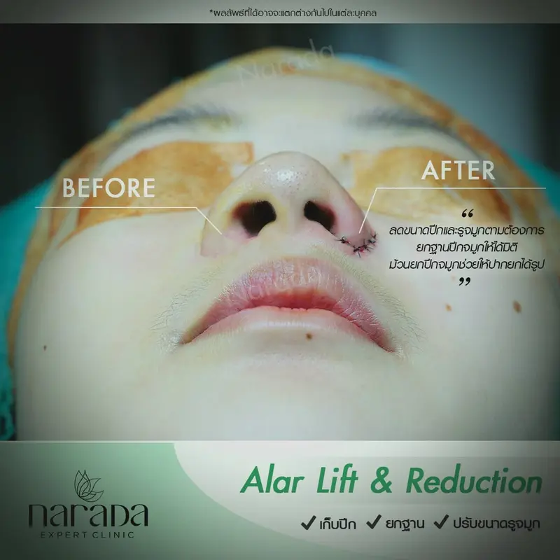 เทียบข้างต่อข้าง Alar Lift & Reduction ที่ นารดาคลินิก