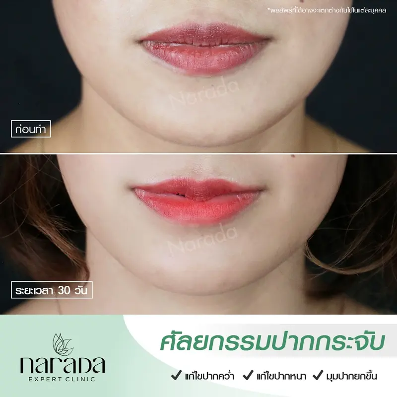 ปากทรงสวยได้รูป ดูเป็นธรรมชาติ ด้วยการศัลยกรรมปากกระจับ ที่ นารดาคลินิก