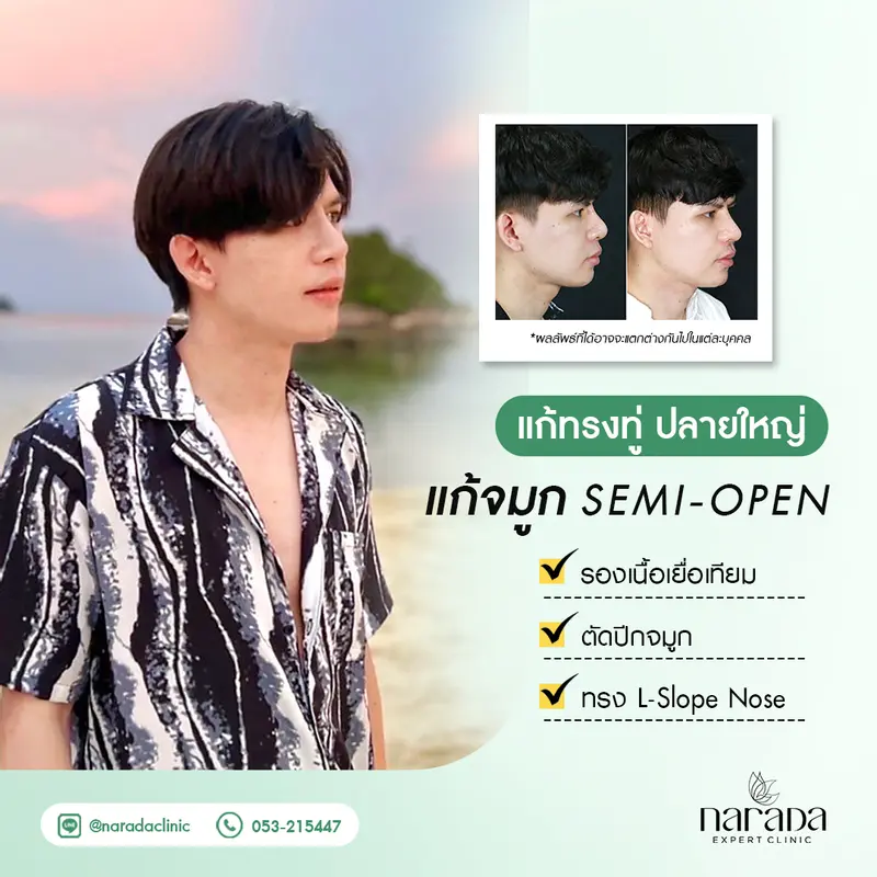 แก้ปัญหาเสริมจมูกมาแล้ว ทรงทู่ ปลายใหญ่ ด้วยเทคนิค Semi-Open รองเนื้อเยื่อเทียม +ตัดปีกจมูก 
