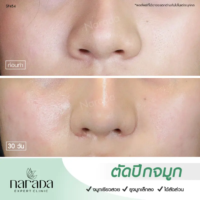 ปรับสัดส่วนจมูกให้สวยงามได้รูป ดูธรรมชาติ ด้วยการตัดปีกจมูก ที่ นารดาคลินิก