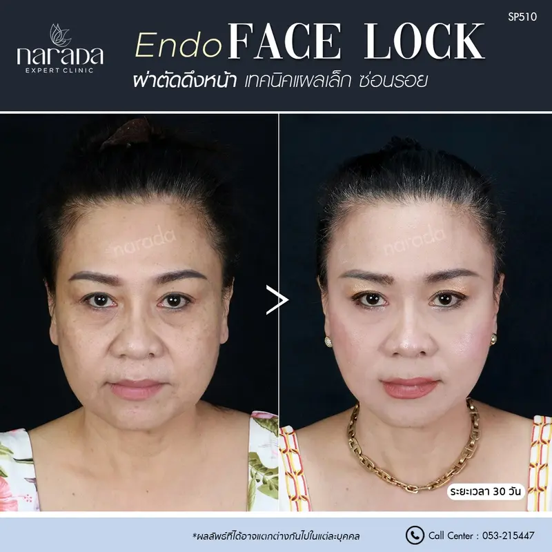 คืนความอ่อนเยาว์ให้กับใบหน้า แผลเล็ก เจ็บน้อย หายเร็ว ด้วยการผ่าตัดดึงหน้า Endo Face Lock  
