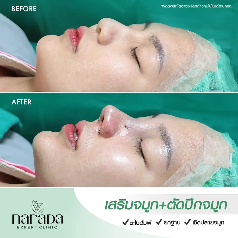 จมูกพุ่งเรียวสวย เข้ากับใบหน้า โดยใช้เทคนิค Semi-Open รองเนื้อเยื่อเทียม & ตัดปีกจมูก 