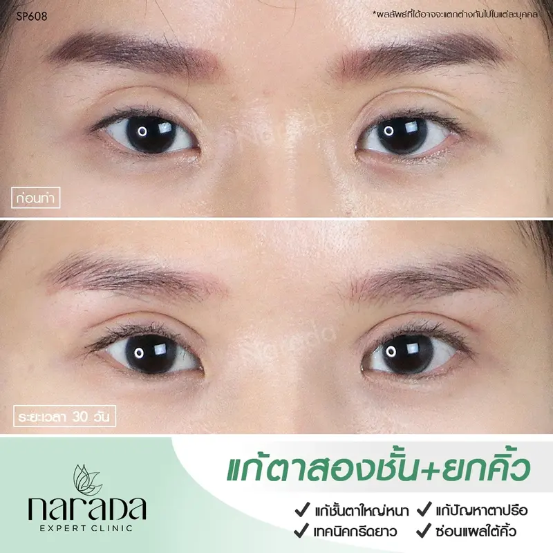ปัญหาทำตามาแล้วชั้นตาใหญ่หนา และมีปัญหาตาปรือ แก้ไขโดยการ แก้ตาสองชั้น+ผ่าตัดยกคิ้ว ที่ นารดาคลินิก