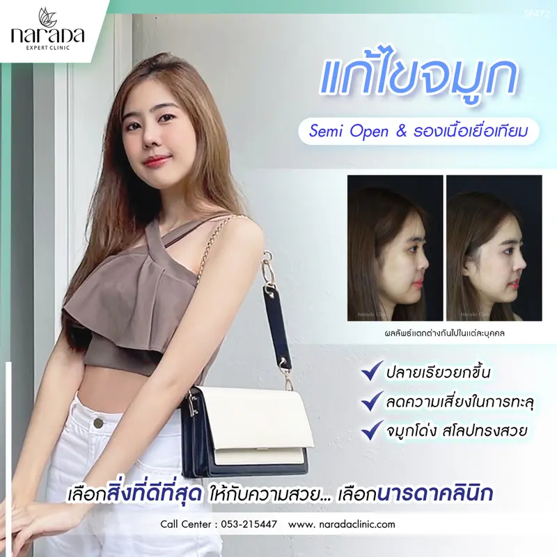แก้จมูกทรงสวย แลดูอย่างเป็นธรรมชาติ เทคนิค Semi Open + รองเนื้อเยื่อเทียม