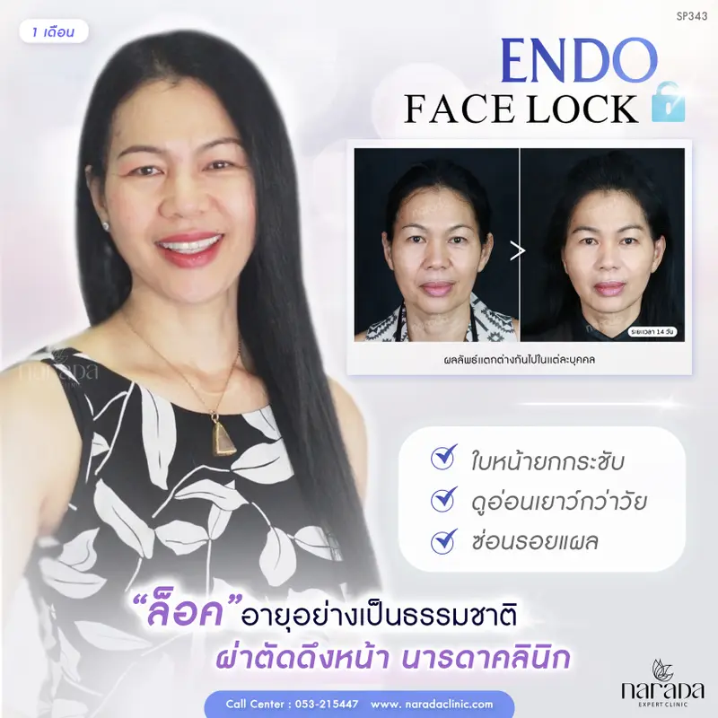 ล็อคอายุ ให้อยู่คู่กับคุณให้นาน ด้วยการผ่าตัดดึงหน้า เทคนิค Endo Face-Lock