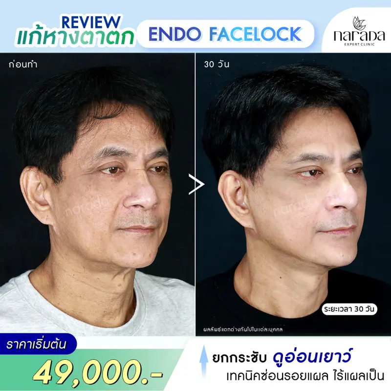 กลับมาหน้าอ่อนเยาว์ ด้วย Endo Face Lock เทคนิคแผลเล็กซ่อนรอย ที่ นารดาคลินิก