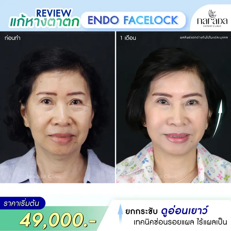 กลับมาหน้าอ่อนเยาว์ ด้วย Endo Face Lock เทคนิคแผลเล็กซ่อนรอย ที่ นารดาคลินิก