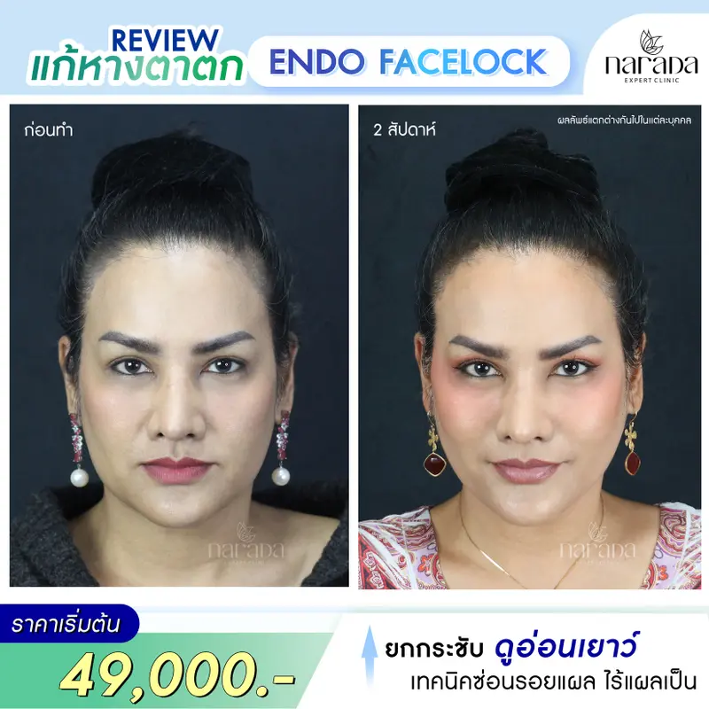 กลับมาหน้าอ่อนเยาว์ ด้วย Endo Face Lock เทคนิคแผลเล็กซ่อนรอย ที่ นารดาคลินิก