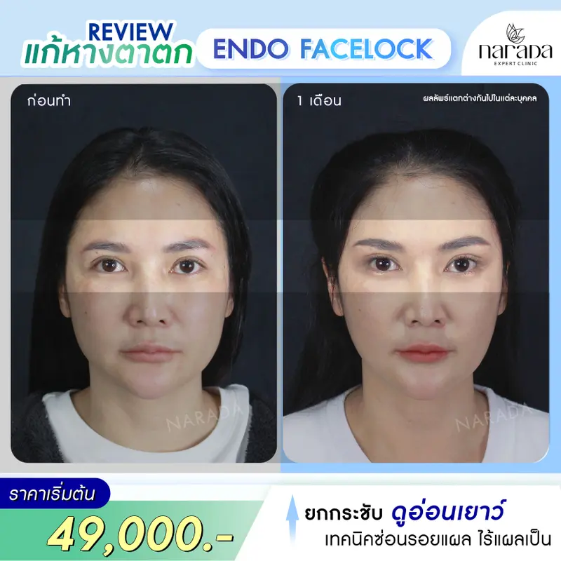กลับมาหน้าอ่อนเยาว์ ด้วย Endo Face Lock เทคนิคแผลเล็กซ่อนรอย ที่ นารดาคลินิก