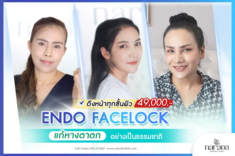 กลับมาหน้าอ่อนเยาว์ ด้วย Endo Face Lock เทคนิคแผลเล็กซ่อนรอย ที่ นารดาคลินิก