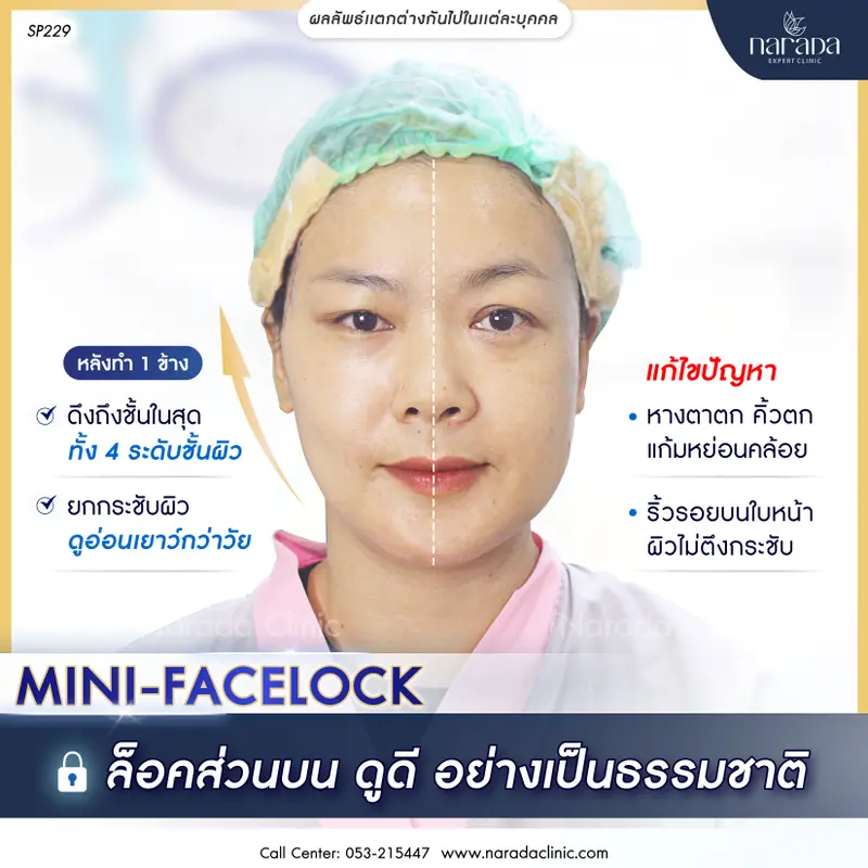 ล็อคความเยาว์วัย อย่างเป็นธรรมชาติ ด้วย Mini Facelock
