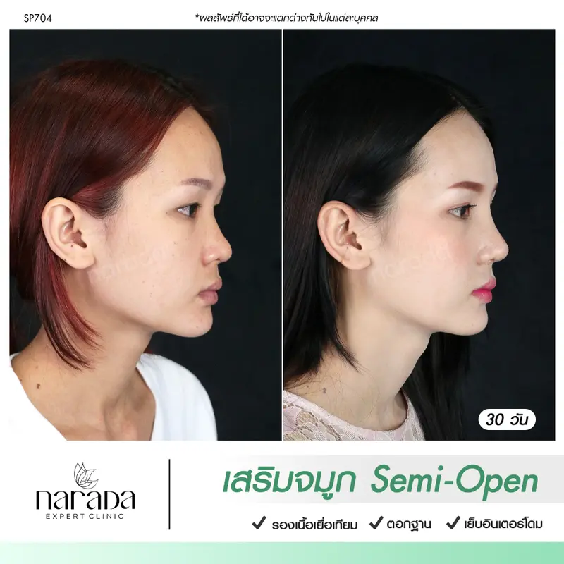 เพิ่มมิติให้กับใบหน้า ด้วยจมูกทรงสวย เทคนิค Semi-Open