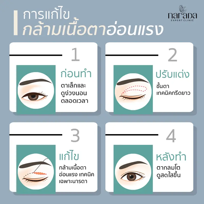 การแก้ไขกล้ามเนื้อตาอ่อนแรง เทคนิคเฉพาะแพทย์ ที่นารดาคลินิก