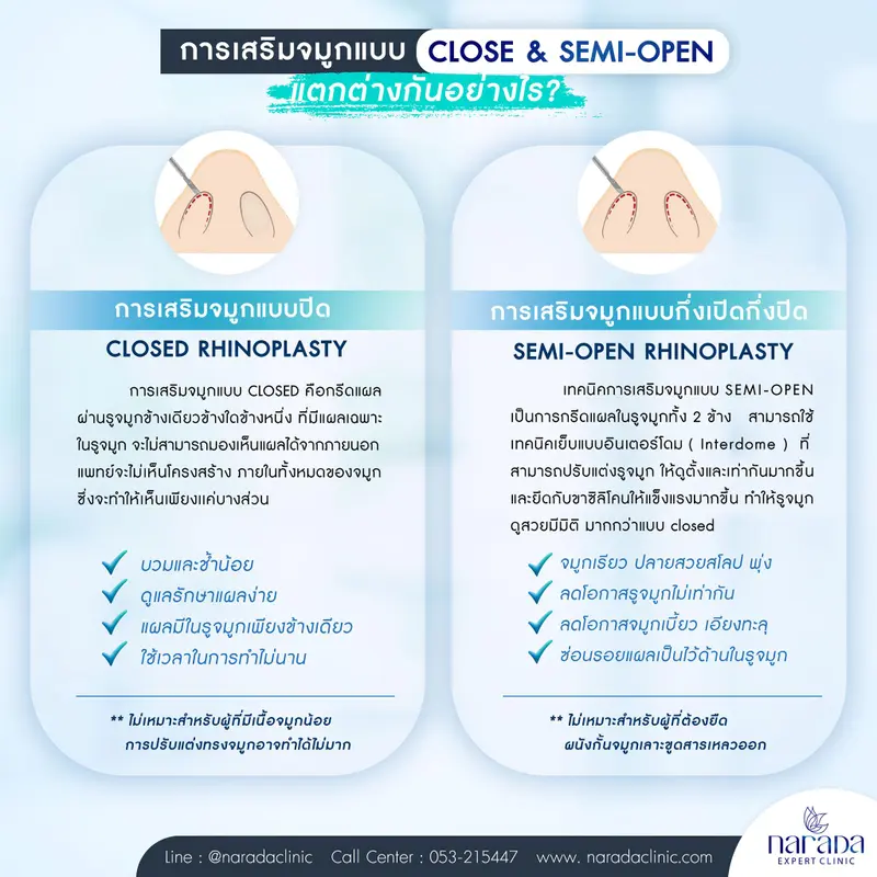 เสริมจมูกแบบ Close & Semi-Open แตกต่างกันอย่างไร นารดาคลินิก มีคำตอบ