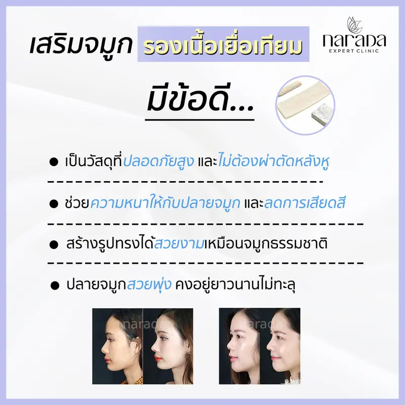 สริมจมูก รองเนื้อเยื่อเทียมเป็นอย่างไร นารดาคลินิกมีคำตอบ