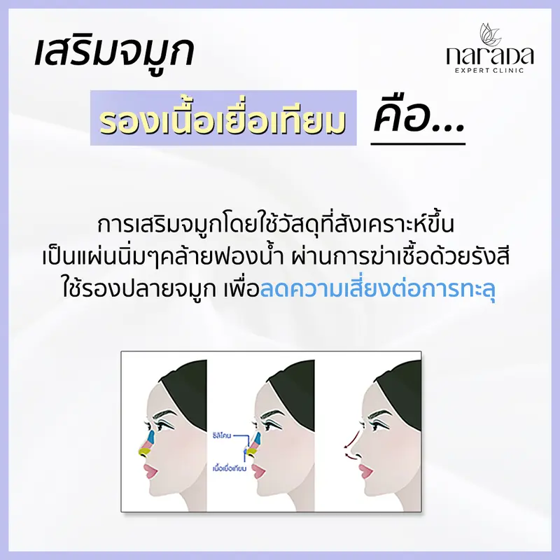 เสริมจมูก รองเนื้อเยื่อเทียมเป็นอย่างไร นารดาคลินิกมีคำตอบ