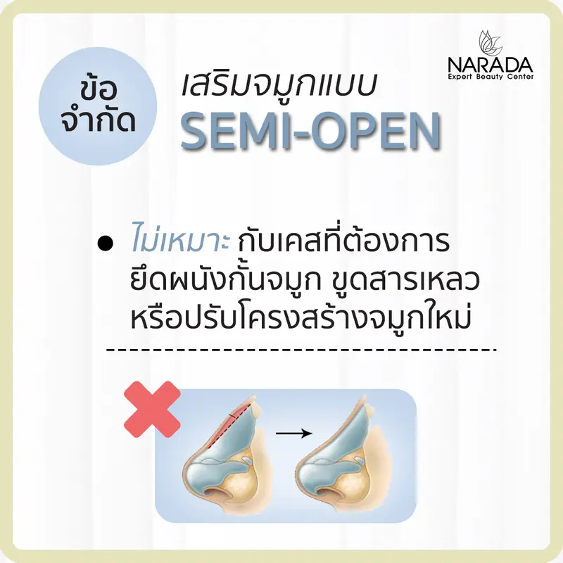 ข้อจำกัดการเสริมจมูกแบบ Semi-open