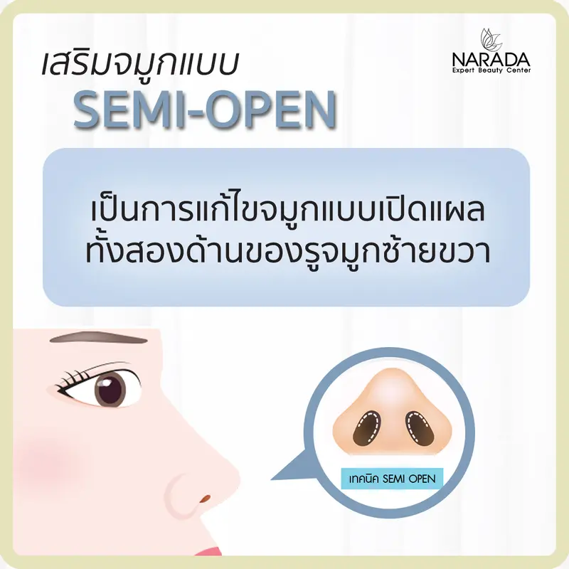 การเสริมจมูกเทคนิค semi-open