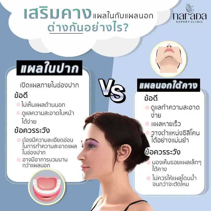 เสริมคางแผลใน VS แผลนอกต่างกันอย่างไร ?